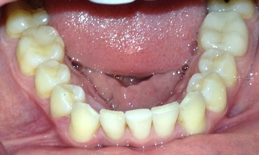 After Invisalign