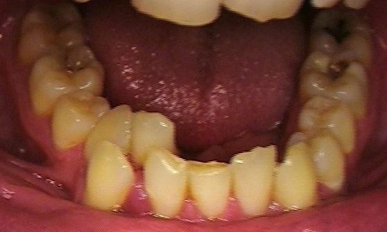 Before Invisalign