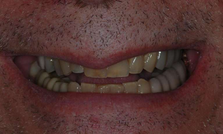 Dental-Implants-After-Image