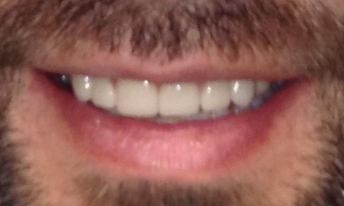 Veneers-and-restorative-bonding-After-Image