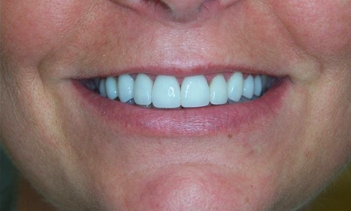 Veneers-After-Image