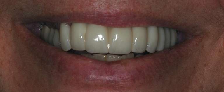 Crowns-and-Dental-implants-After-Image