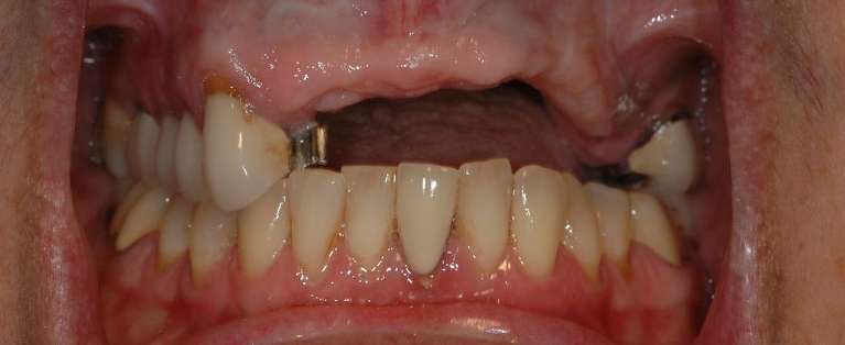 Crowns-and-Dental-implants-Before-Image