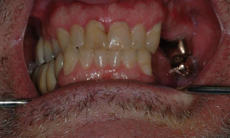 Dental-Implants-Before-Image