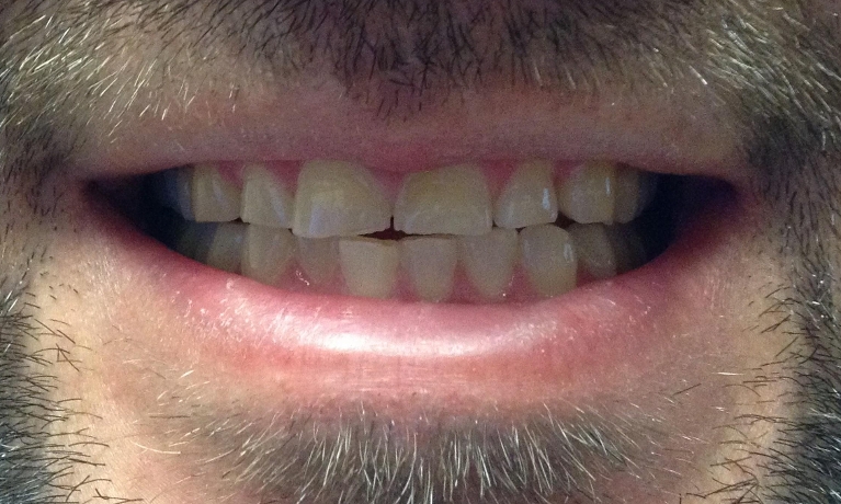 Veneers-and-restorative-bonding-Before-Image